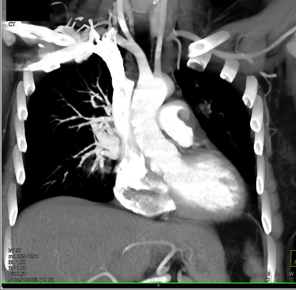 Pulmonary Artery Sarcoma - CTisus CT Scan