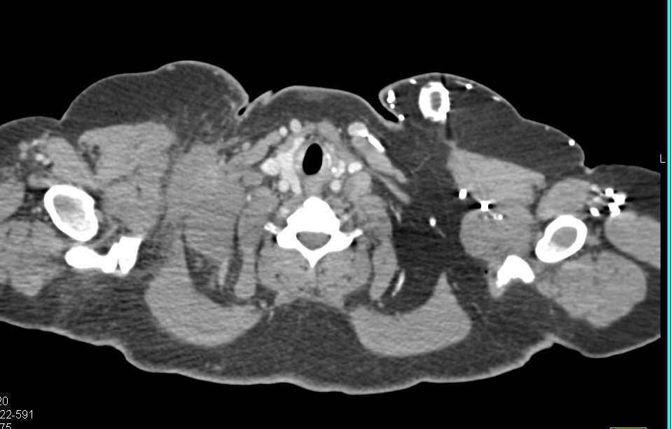 Lymphoma with Extensive Adenopathy - CTisus CT Scan