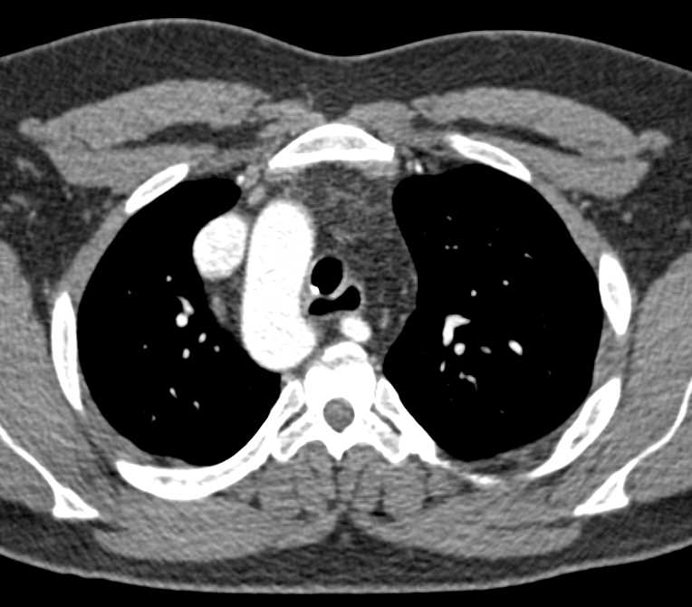 Right Aortic Arch with Classic Branch Vessel Anatomy - CTisus CT Scan