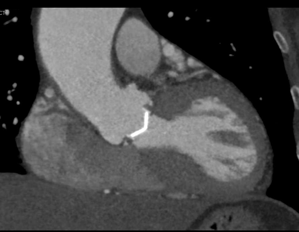 Aortic Valve Replacement (AVR) with Dilated Ascending Aorta - CTisus CT Scan