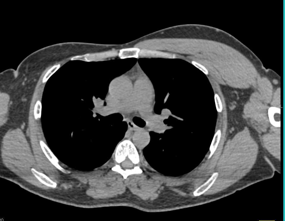 Absent Right Pectoralis Major Muscle - CTisus CT Scan