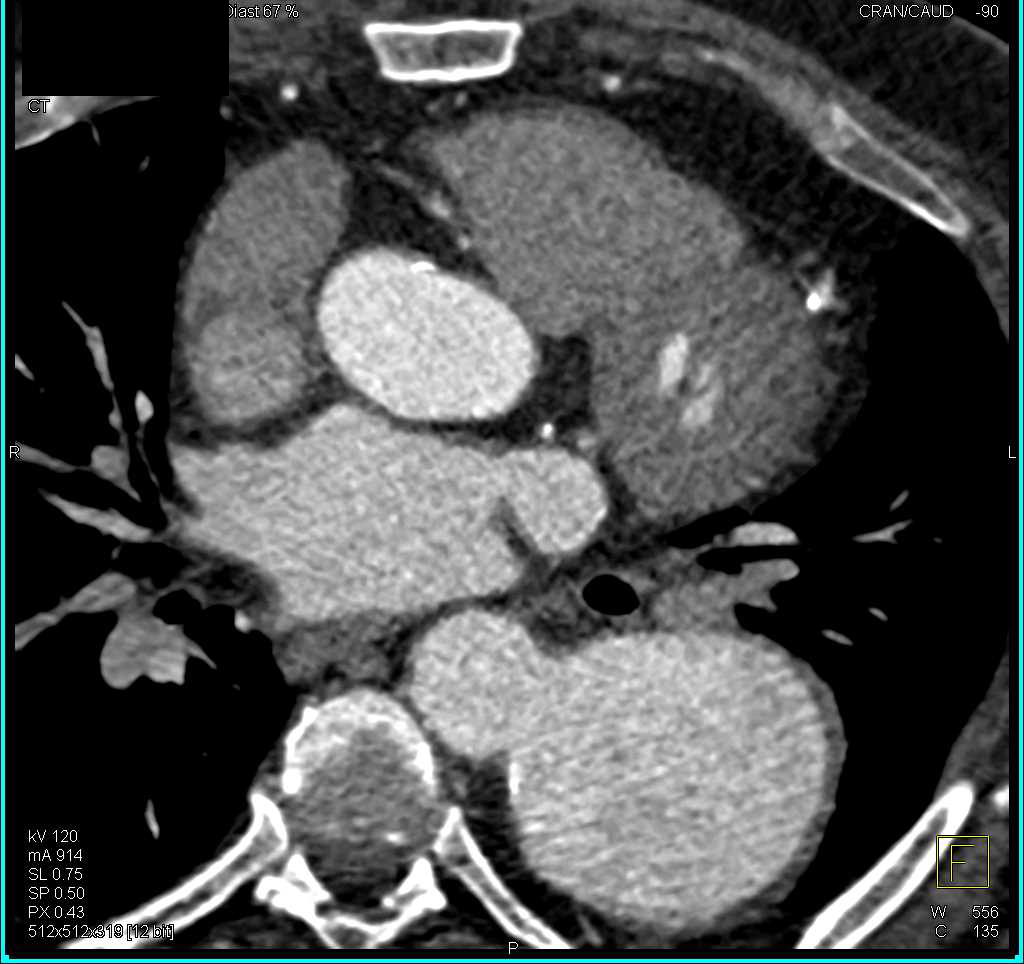 Aortic Aneurysm with Dissection - CTisus CT Scan