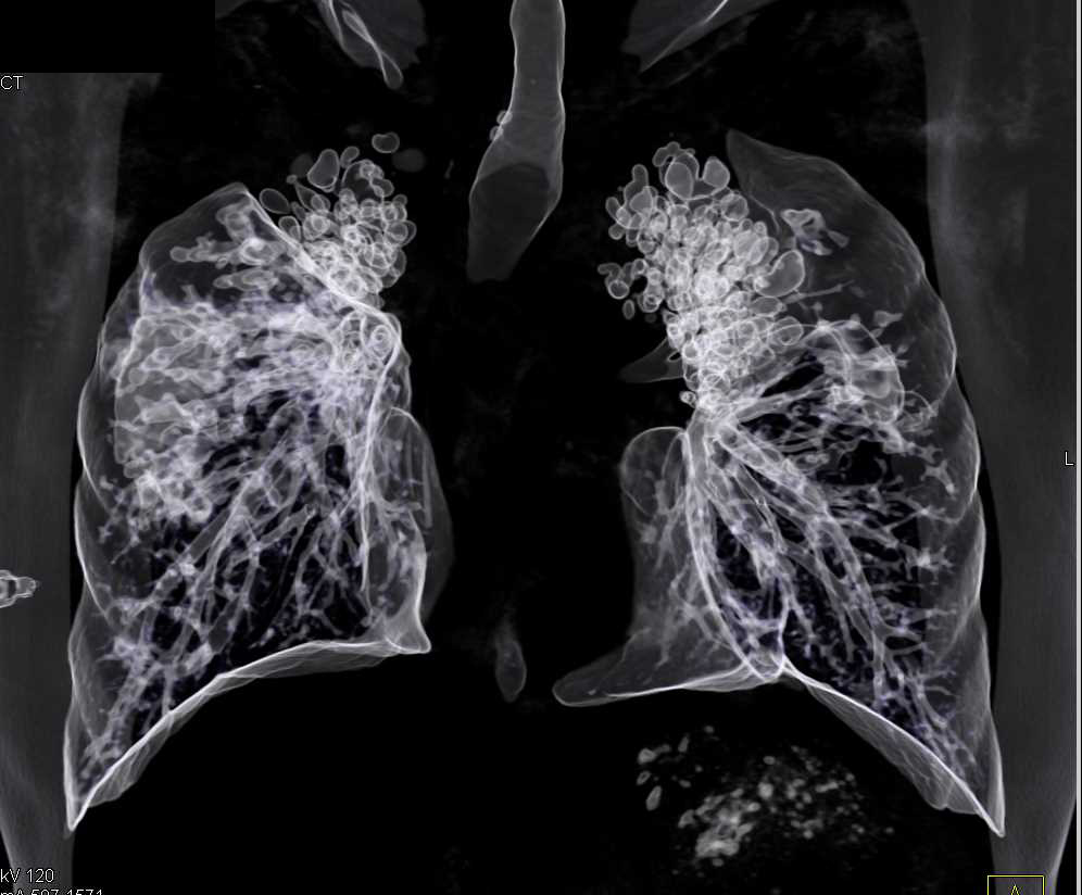Bronchiectasis with Cystic Fibrosis - CTisus CT Scan