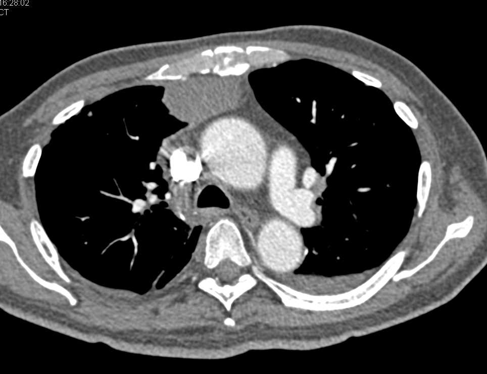 Lymphoma Involves Mediastinum and Pericardium - CTisus CT Scan