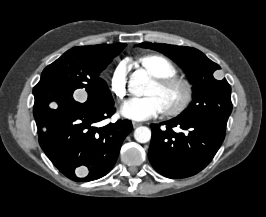 Hepatocellular Carcinoma (Hepatoma) Metastatic to Lungs and Bone - CTisus CT Scan