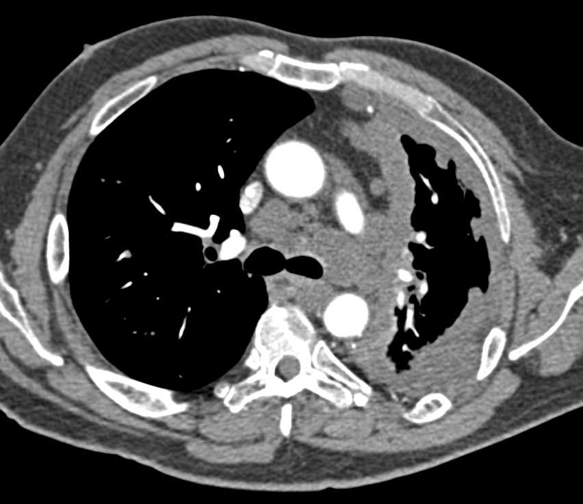 Infiltrating Lung Cancer with Pleural Implants and Nodes in the Abdomen - CTisus CT Scan