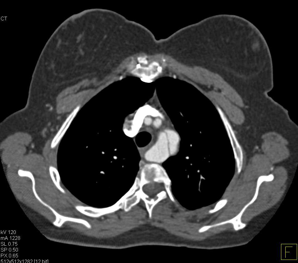 Dissection Involves an Aberrant Left Subclavian Artery - CTisus CT Scan