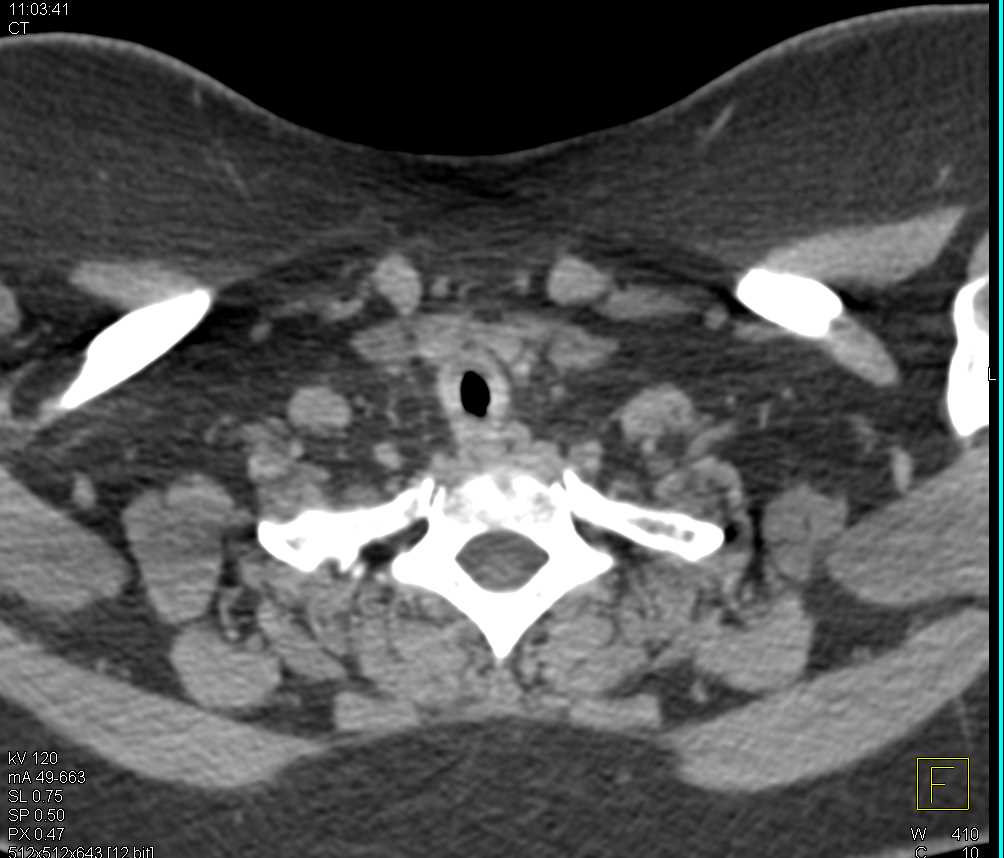 Tracheal Stenosis with Virtual Bronchoscopy - CTisus CT Scan