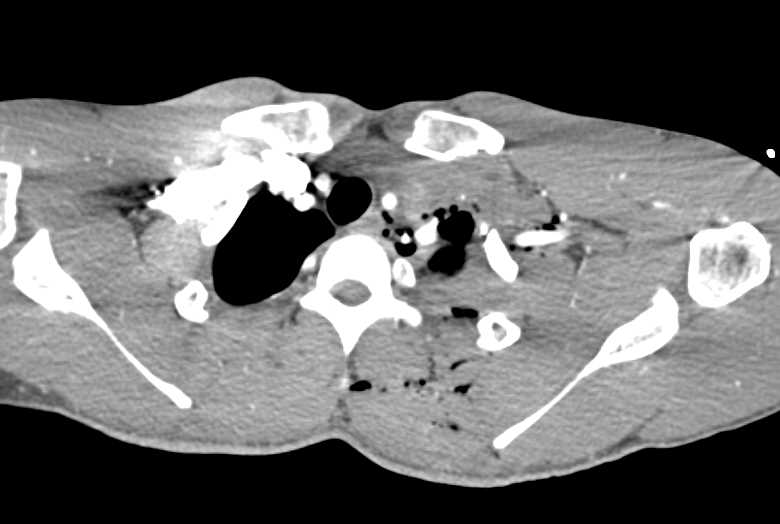 GSW with Lung, Bone and Muscle Injury - CTisus CT Scan