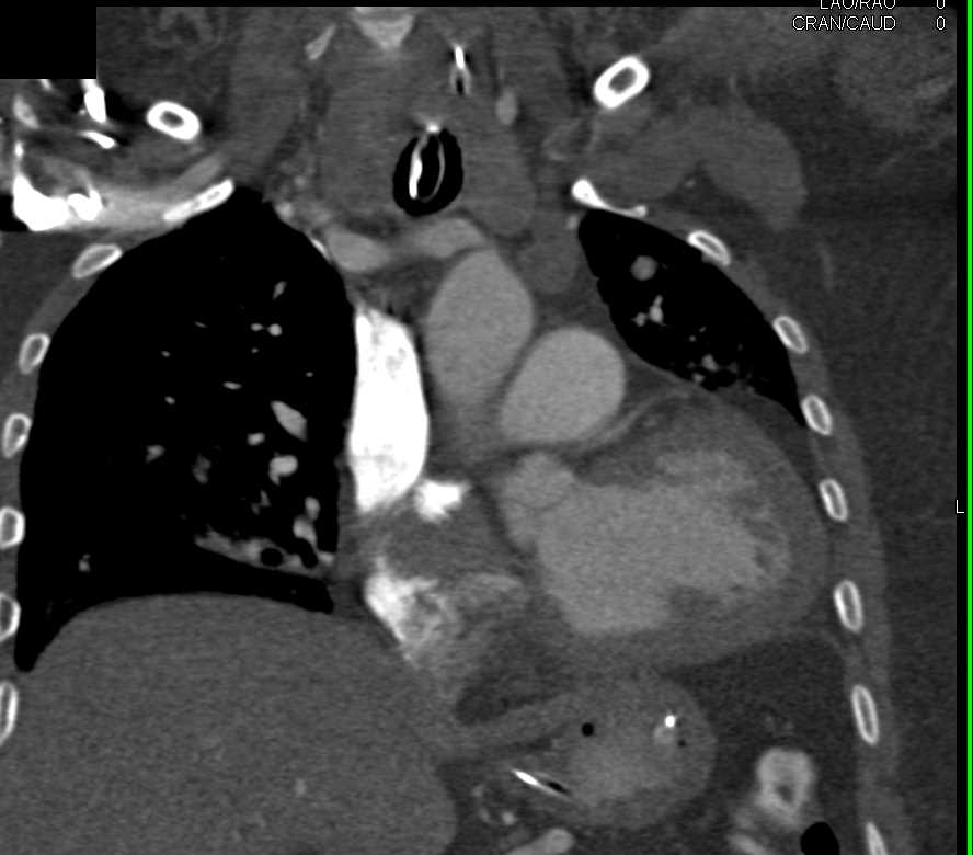 Horseshoe Kidneys with Cysts - CTisus CT Scan