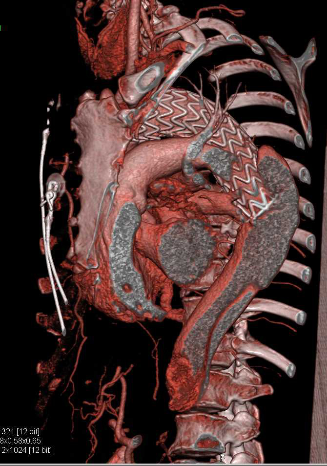 Endovascular Stent Repair Thoracic Aorta - CTisus CT Scan
