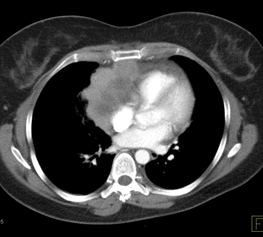 Mediastinal Thymoma - CTisus CT Scan