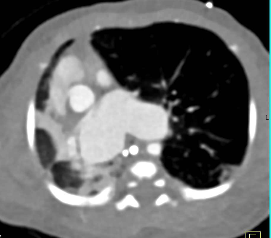 Hypoplastic Right Lung - CTisus CT Scan
