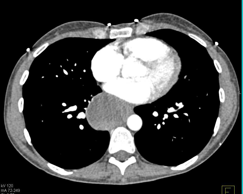 Bronchogenic Cyst - CTisus CT Scan