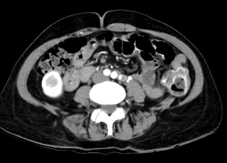 Ischemic Colitis Left Colon - CTisus CT Scan