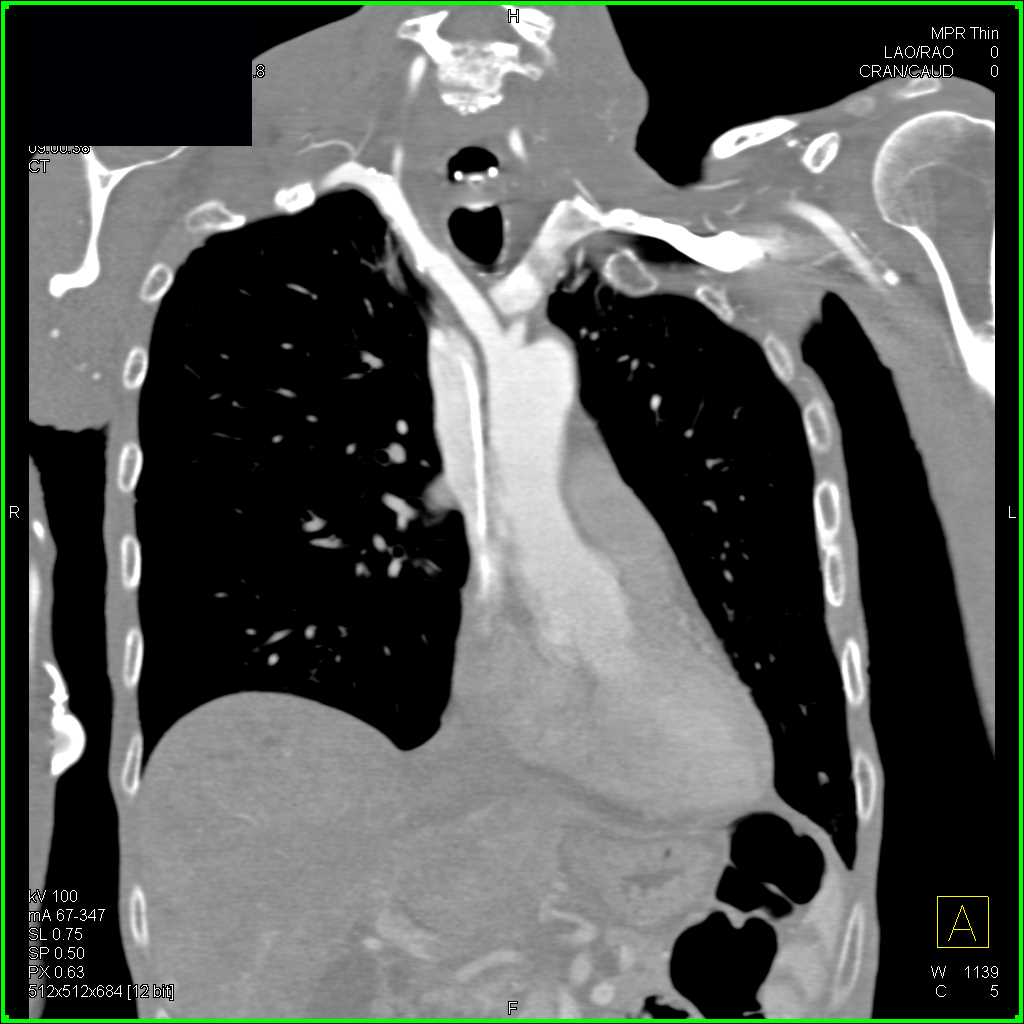 Vascular Mapping of the Vessels off the Arch with MIP - CTisus CT Scan