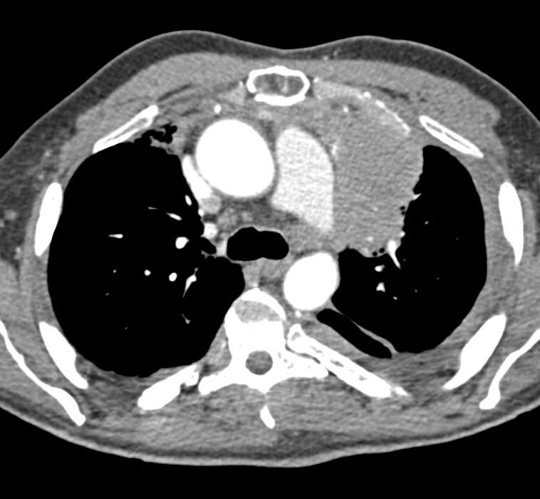 Malignant Thymoma with Bone and Pleural Metastases - CTisus CT Scan