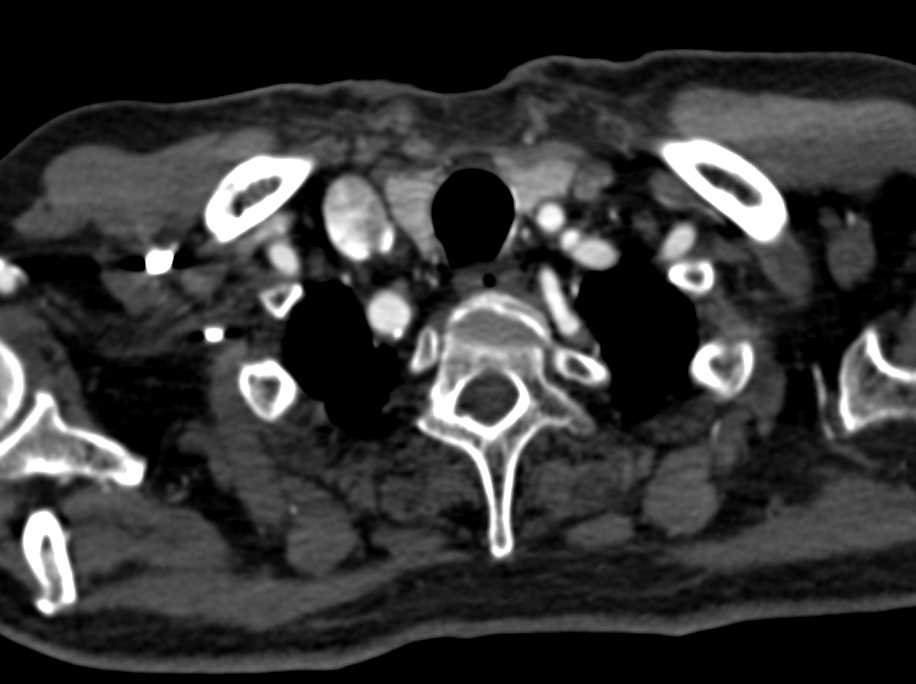 Plaque in Aortic Arch and Incidental Abdominal Aortic Aneurysm (AAA) - CTisus CT Scan