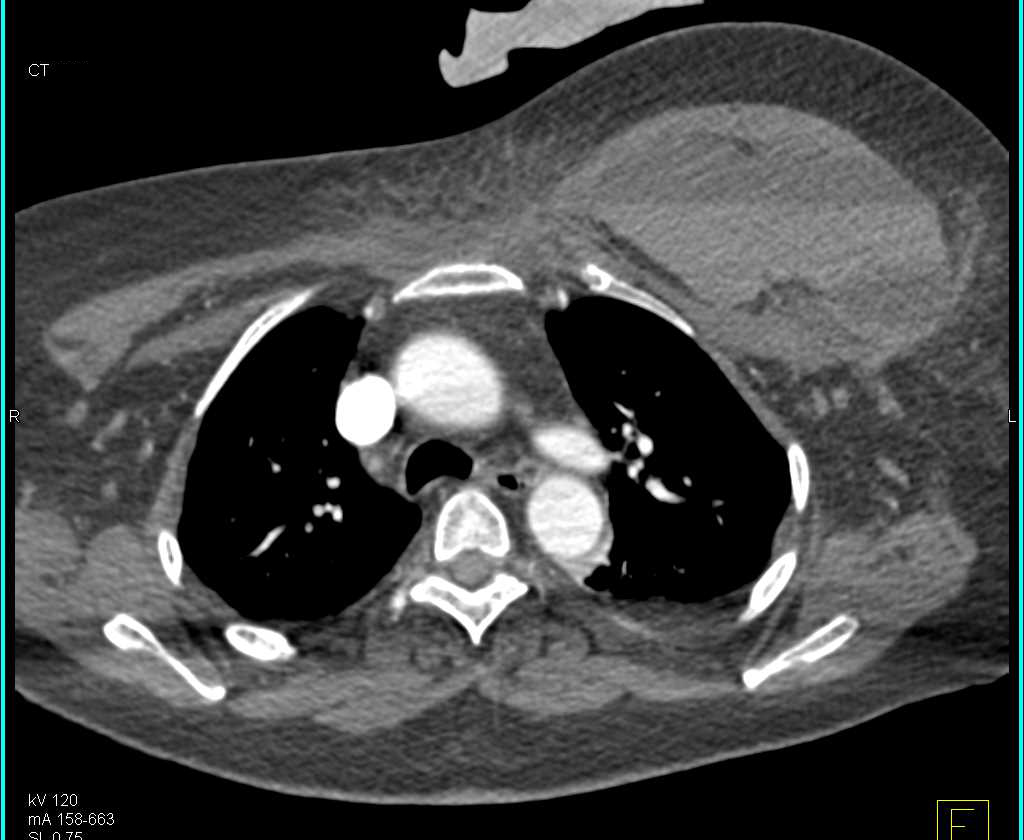 Hematoma with Fluid Level in the Left Breast - CTisus CT Scan