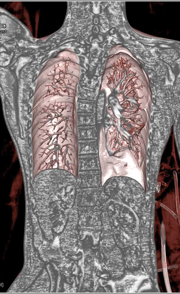 Stab Wound with Pneumothorax - CTisus CT Scan