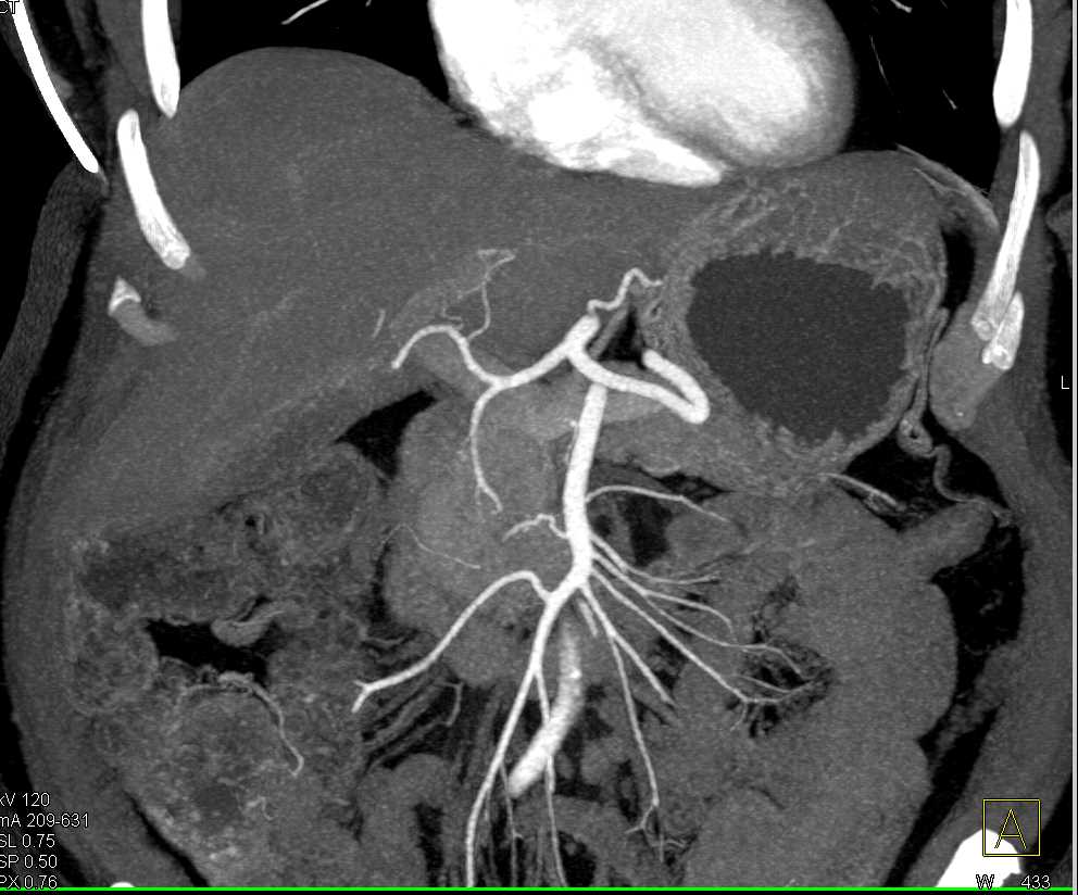 Focal Ulceration of the Ascending Aorta - CTisus CT Scan