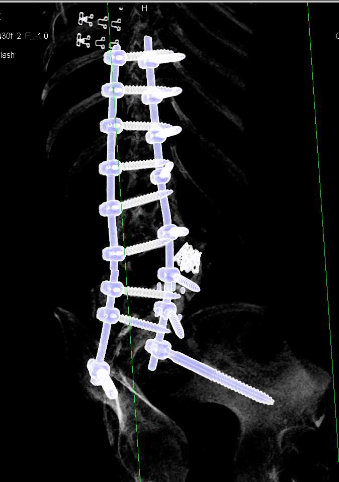 Pulmonary Embolism (PE) in Right Lower Lobe Pulmonary Artery in a Patient Post Spine Surgery - CTisus CT Scan