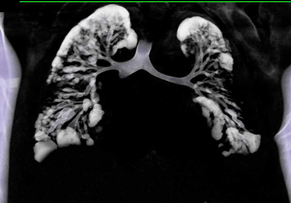 High Density Material in the Lung with Aspiration - CTisus CT Scan