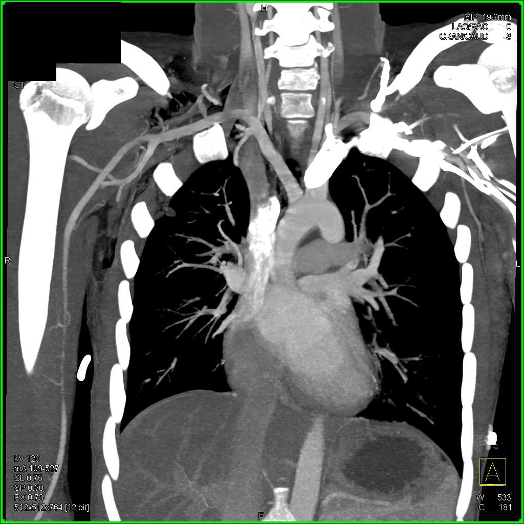 Pneumomediastinum s/p Stab Wound - CTisus CT Scan