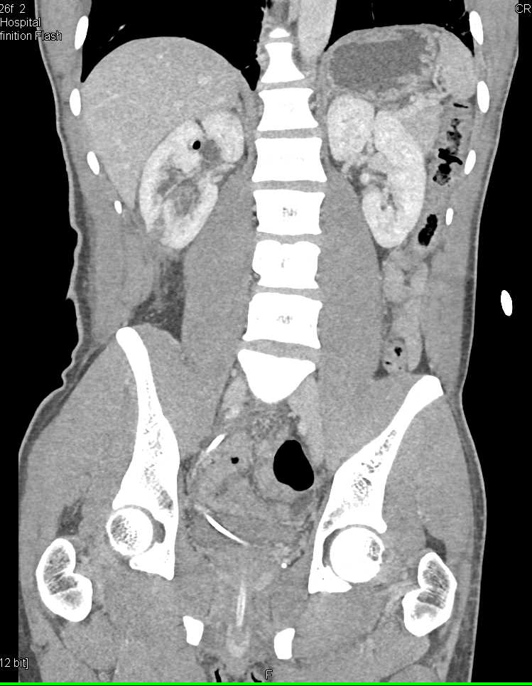 Incidental Left Breast Cancer in Patient with Renal Trauma - CTisus CT Scan