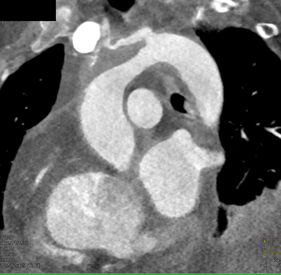 Aortic Dissection with Thrombus in the Arch - CTisus CT Scan