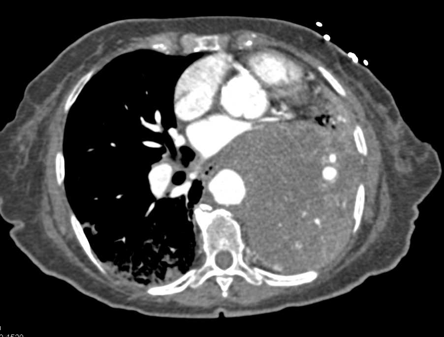 Carcinoma Infiltrates Left Lung - CTisus CT Scan