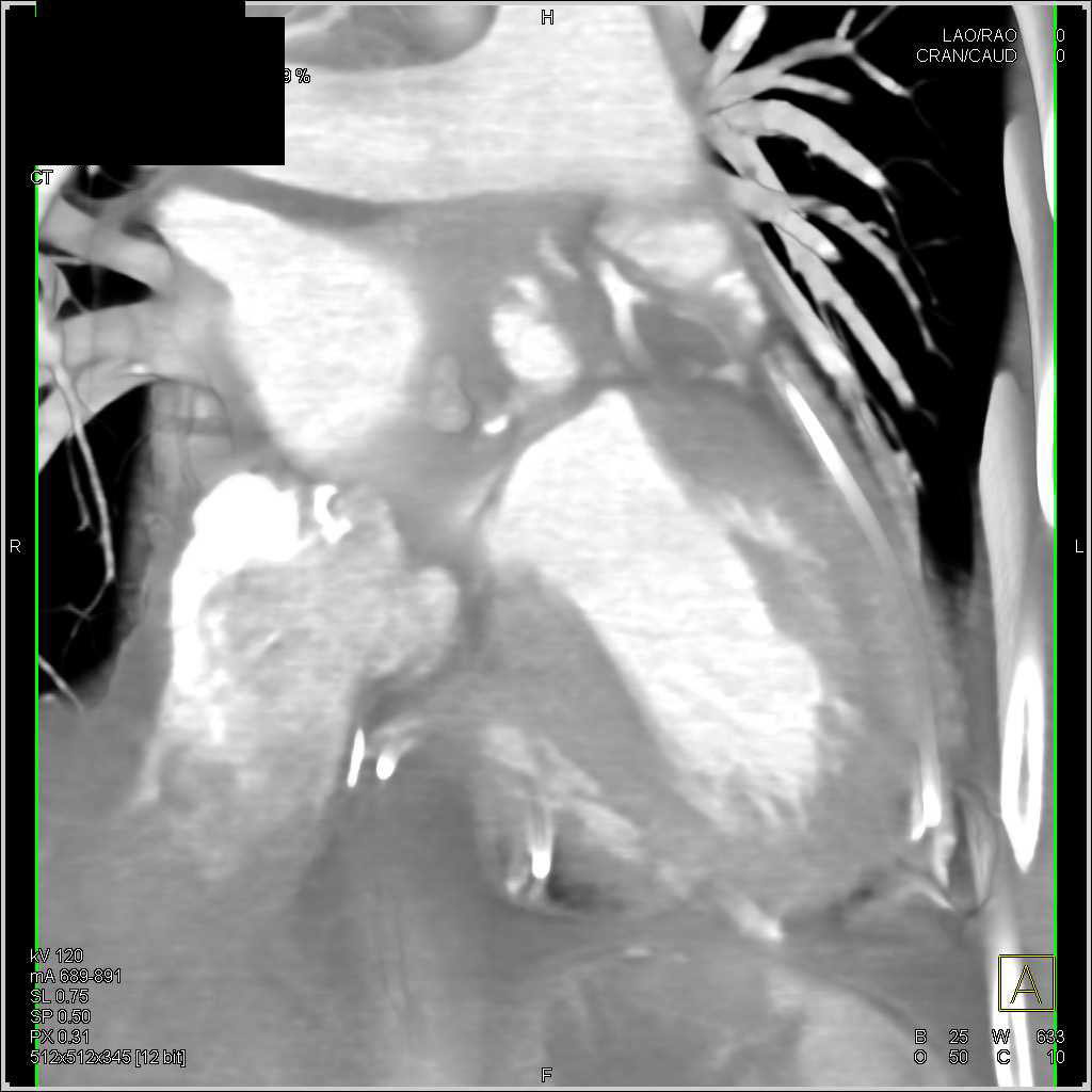Repair of Type A Dissection - CTisus CT Scan