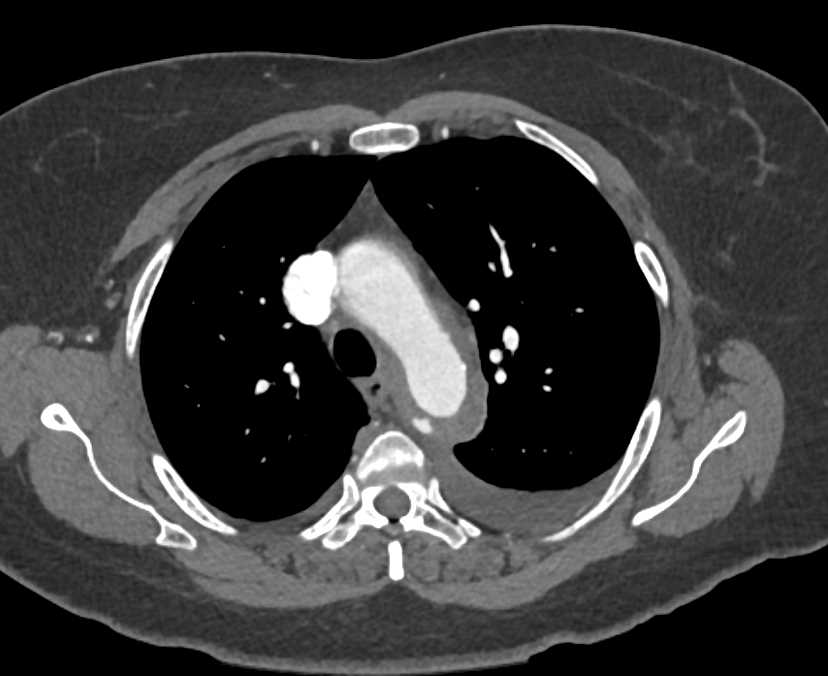 Intramural Hematoma of the Thoracic Aorta - CTisus CT Scan