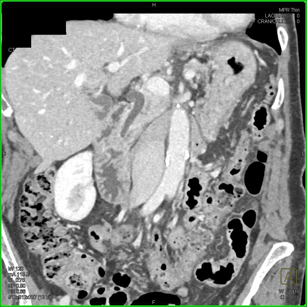 Lymphangitic Spread to the Lung in Patient with Pancreatic Cancer - CTisus CT Scan