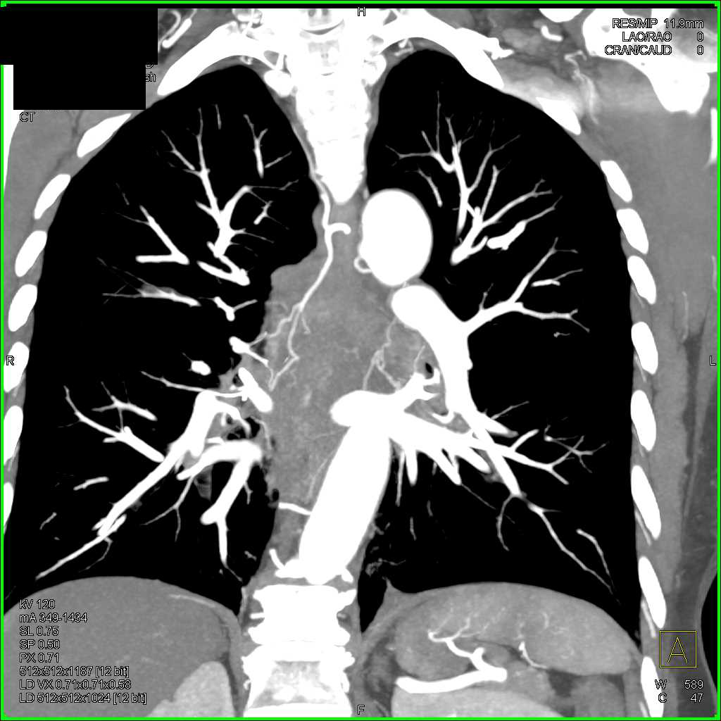 Dilated Bronchial Arteries - CTisus CT Scan