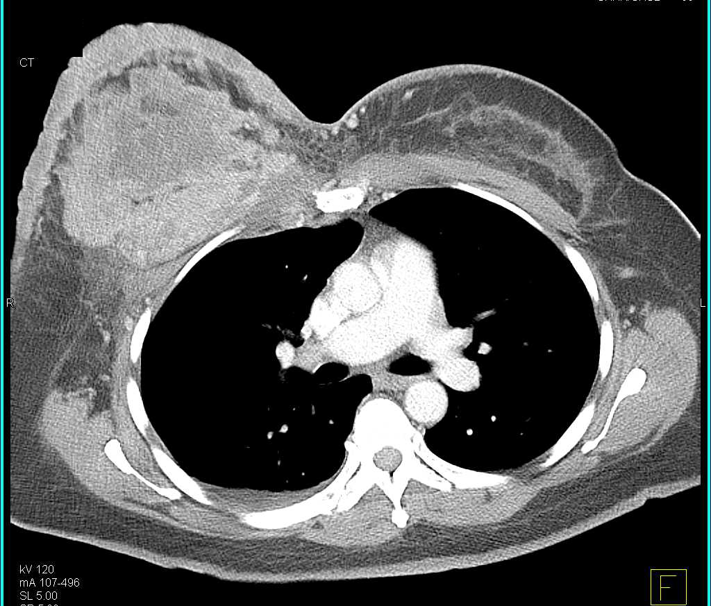Large Ulcerating Carcinoma of the Right Breast - CTisus CT Scan