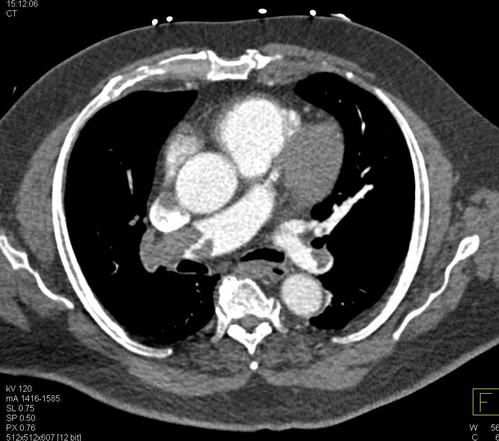 Pulmonary Emboli with Emboli in the Lower Extremities as well - CTisus CT Scan
