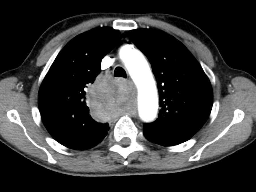 Metastatic Lung Cancer to Lung, Liver and Muscle - CTisus CT Scan