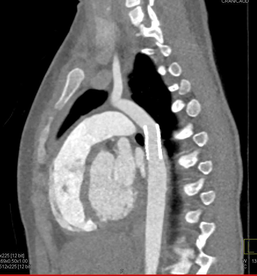 Stent Repair of Coarctation of the Aorta - CTisus CT Scan