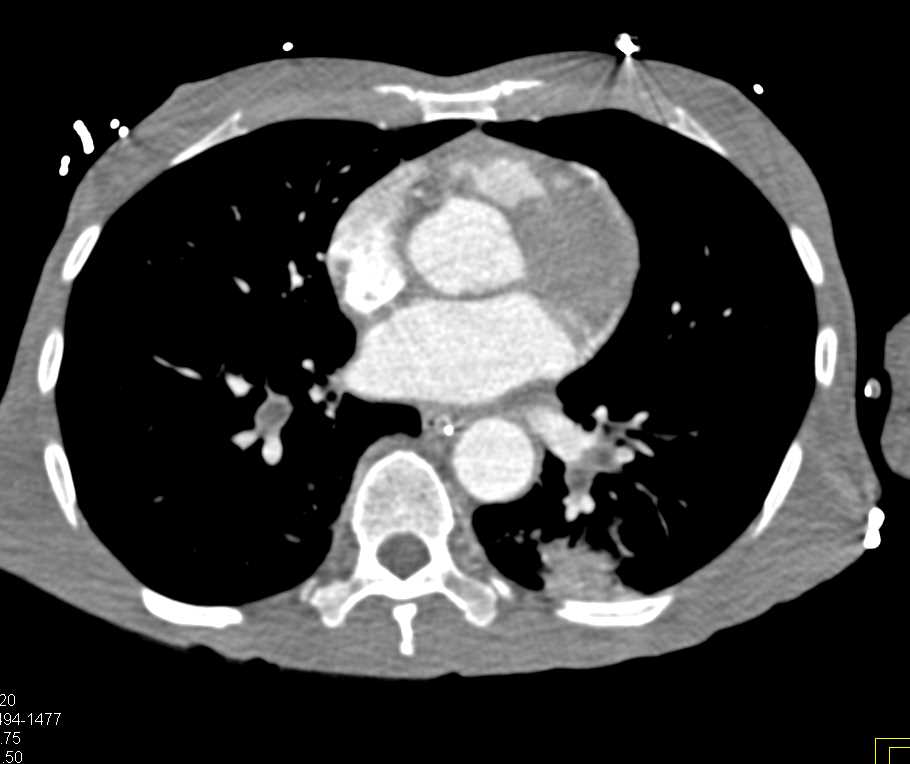 Pulmonary Embolism (PE) with Infarction - CTisus CT Scan