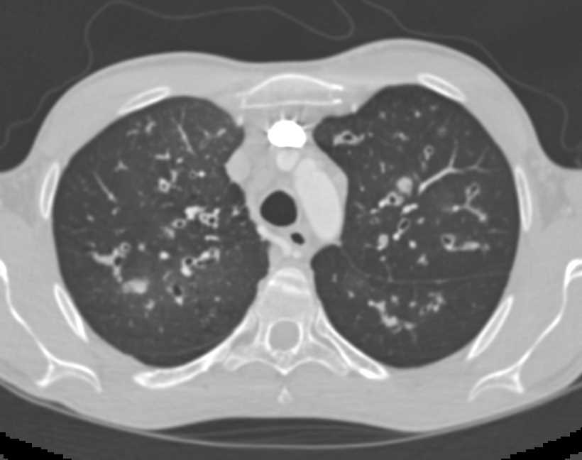Peribronchial Thickening and Bronchiectasis in a Cystic Fibrosis Patient - CTisus CT Scan