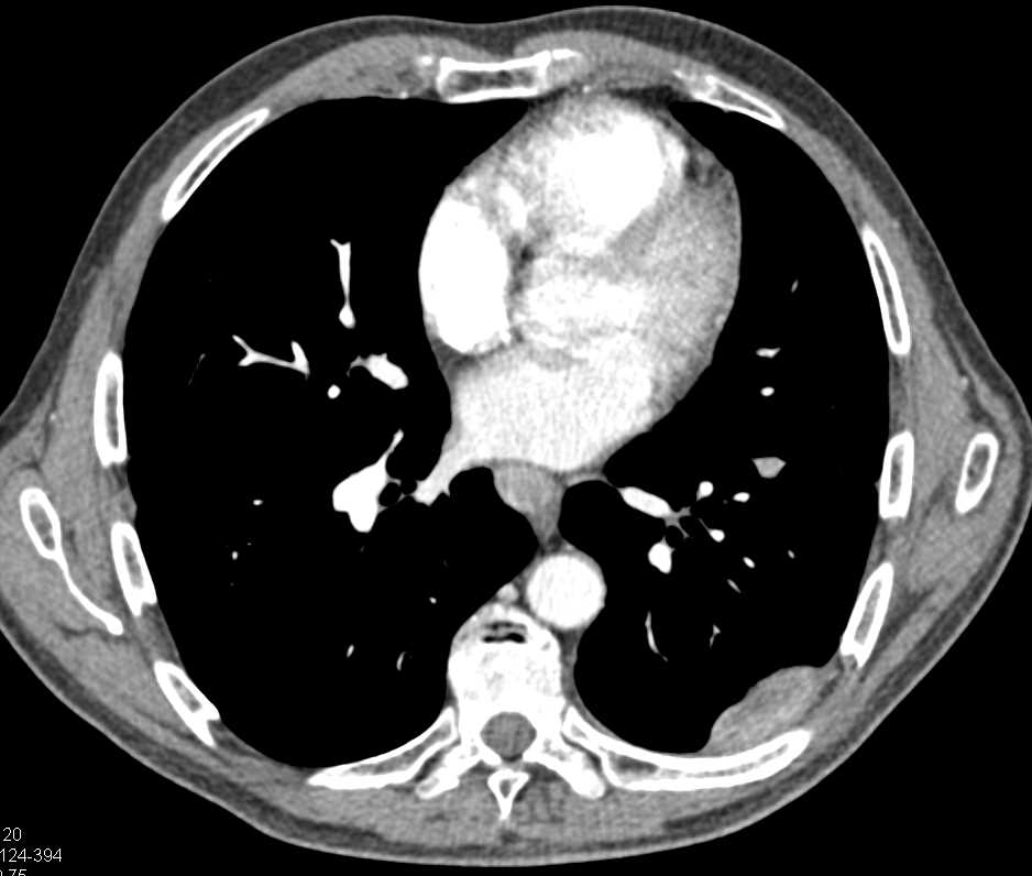Thymoma with Multiple Implants Left Chest - CTisus CT Scan