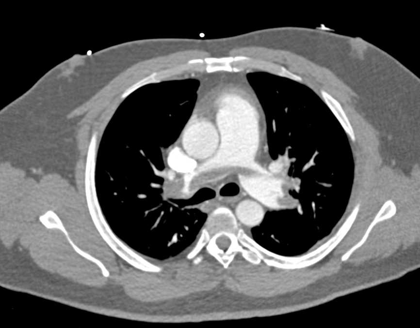 Saddle Pulmonary Embolism - CTisus CT Scan
