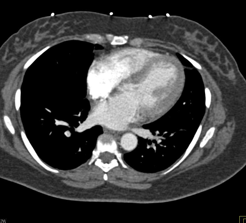 Pulmonary Emboli and Renal and Bladder Cancer - CTisus CT Scan