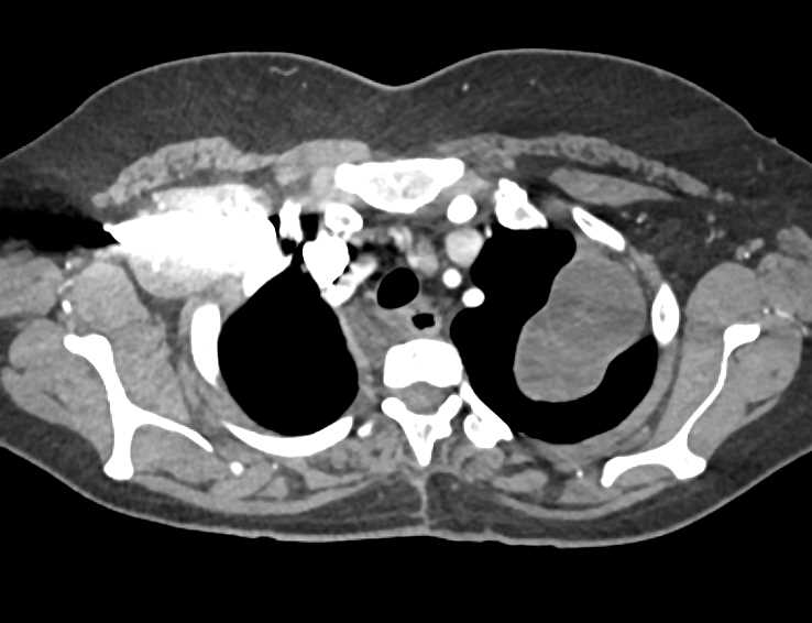Multiple Neurofibromas - CTisus CT Scan