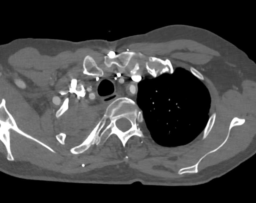 Pancoast Tumor with Vessel Encasement - CTisus CT Scan