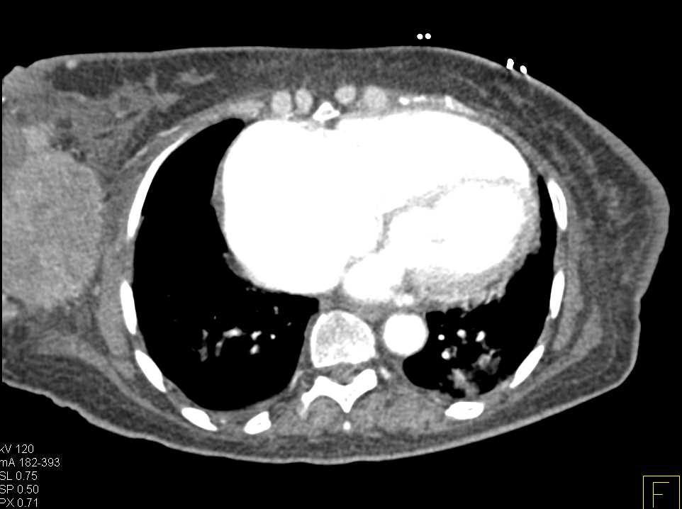 Large Right Breast Cancer with Lymphedema - CTisus CT Scan