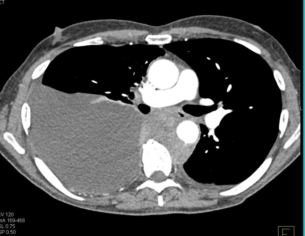 Lymphoma Involves the Posterior Mediastinum - CTisus CT Scan