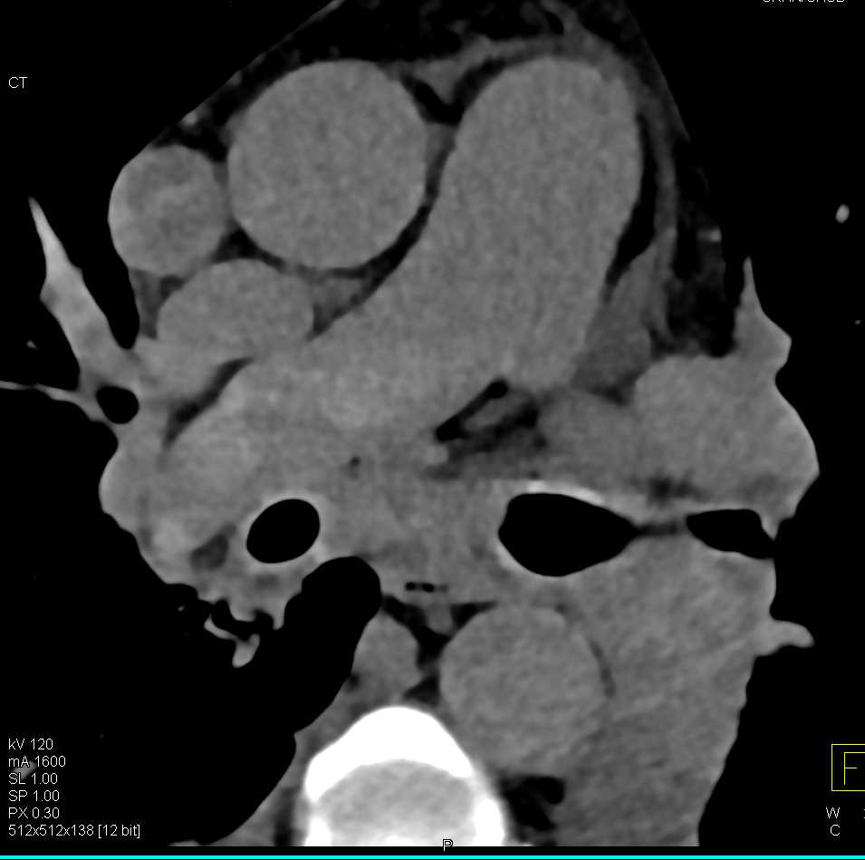 Saddle Pulmonary Embolism (PE) seen on a Noncontrast CT - CTisus CT Scan