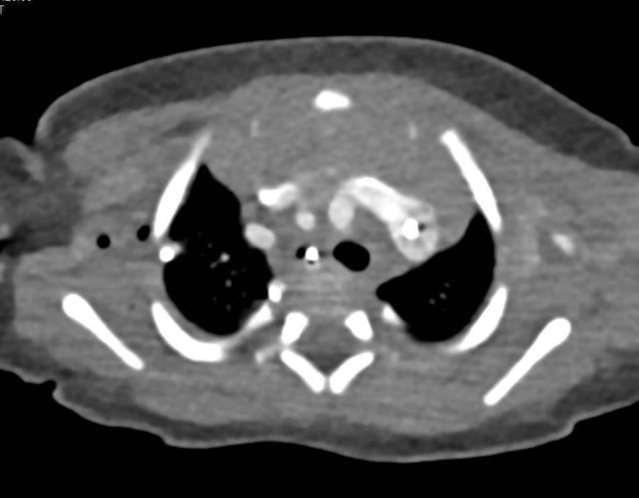 Thymus in Child - CTisus CT Scan